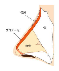 隆鼻術